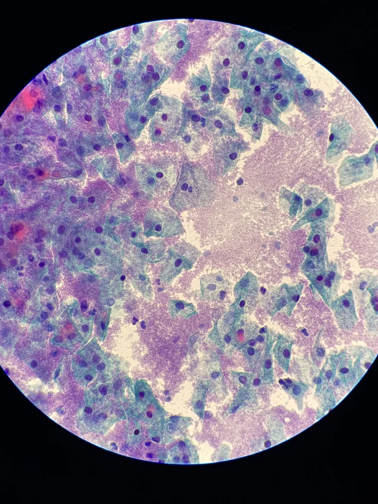 Cervical cytology showing clue cells characteristic of bacterial vaginosis