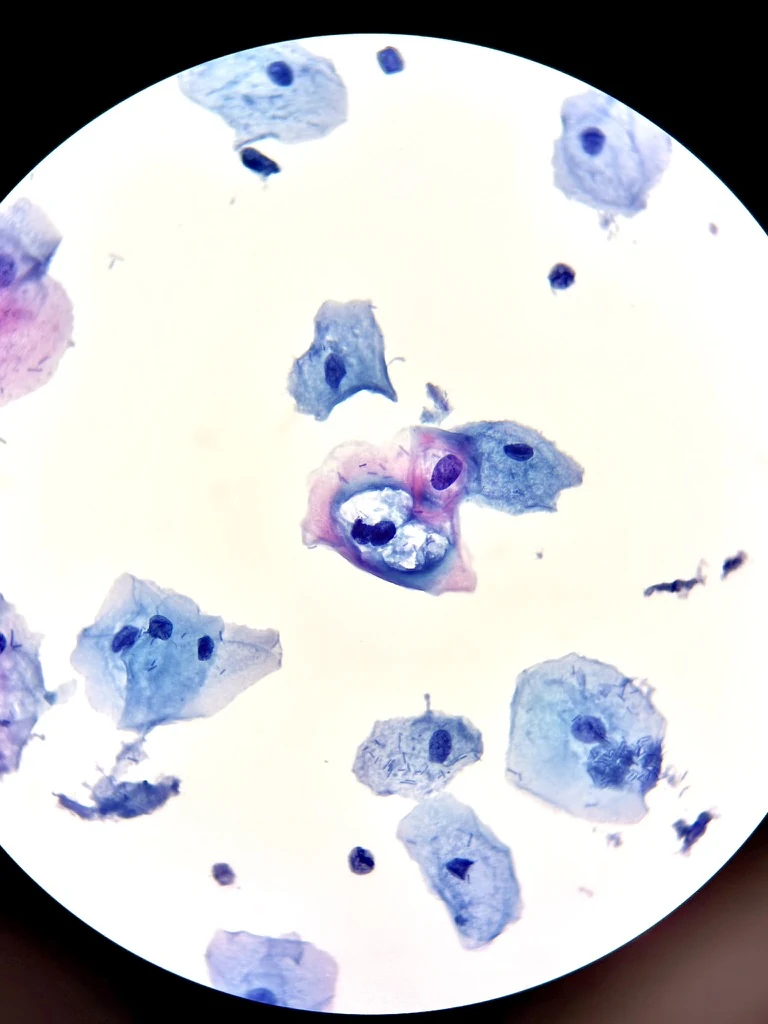 Cervical cytology showing koilocytotic changes characteristic of LSIL