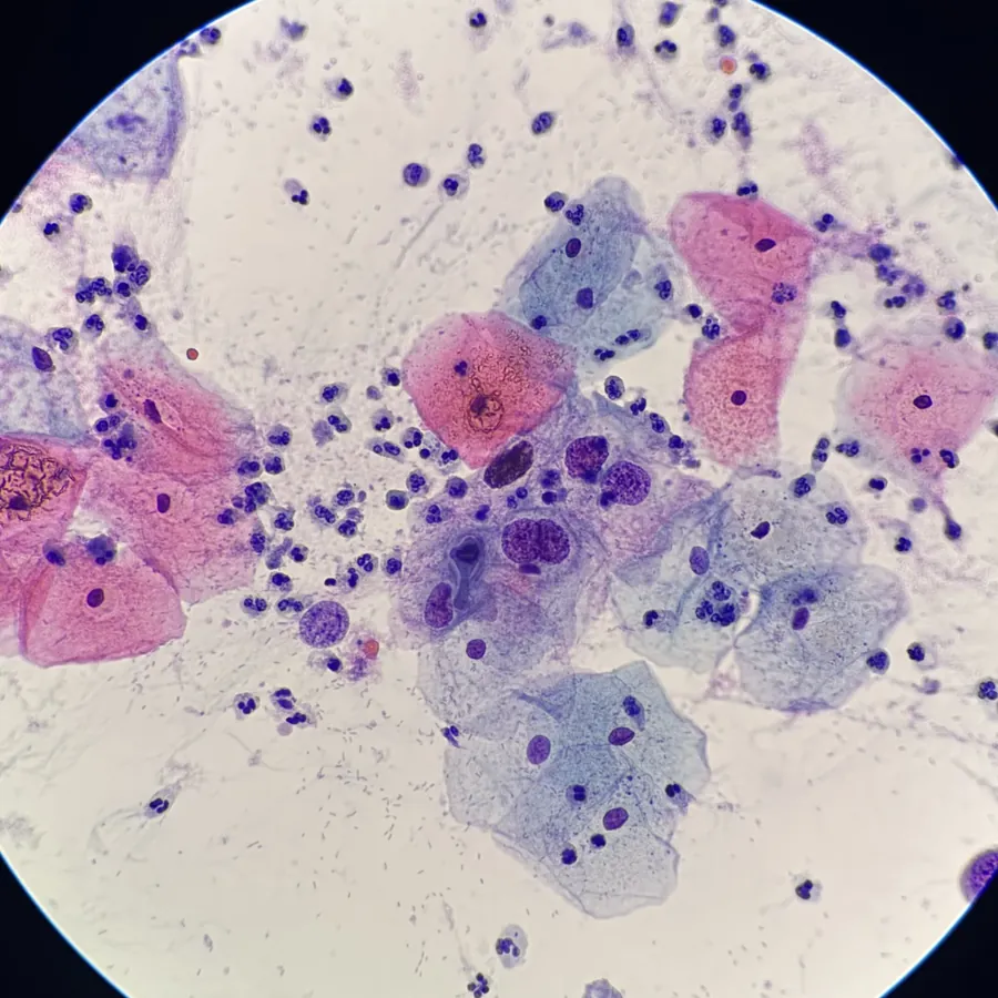 Citología cervical mostrando LSIL con cambios koilocitóticos