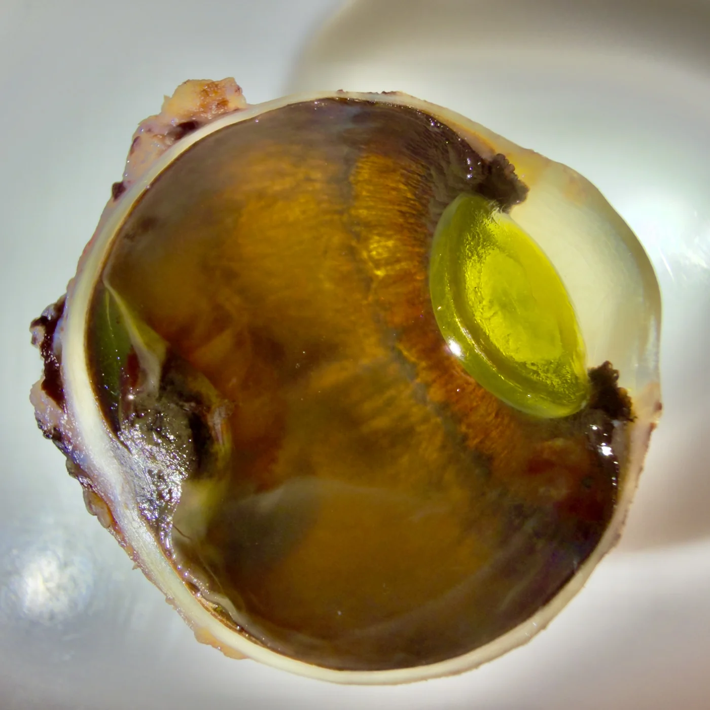 Globo ocular bisecado mostrando un melanoma uveal pigmentado