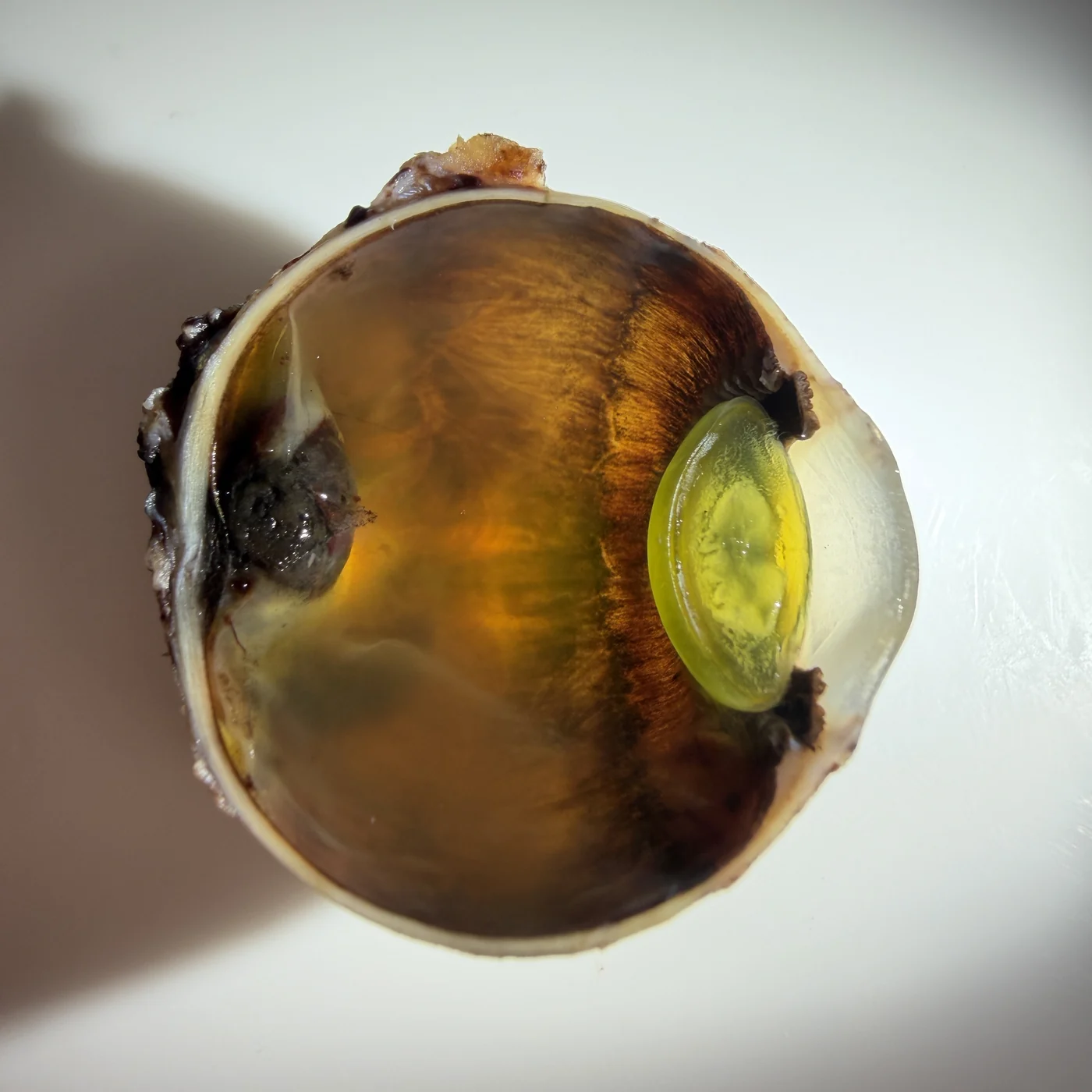 Pieza de globo ocular bisecado, ángulo alternativo mostrando la extensión del melanoma